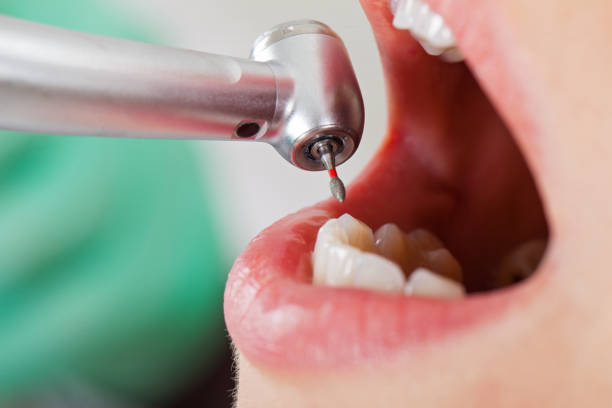 Best Emergency Root Canal Treatment in Fresno, CA